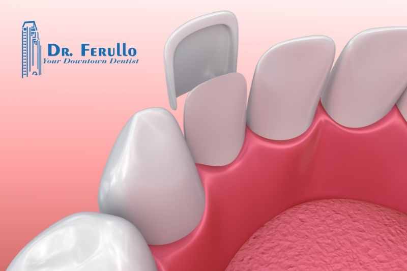 what-are-dental-veneers