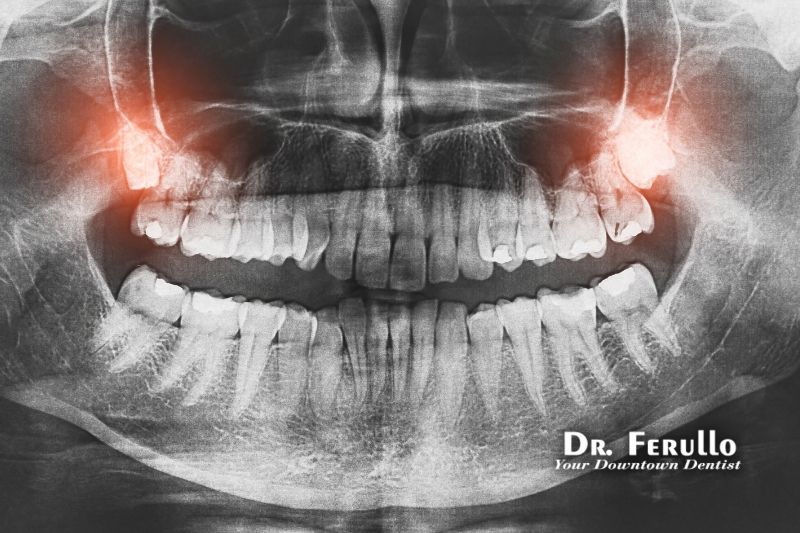 do-you-have-to-get-your-wisdom-teeth-removed