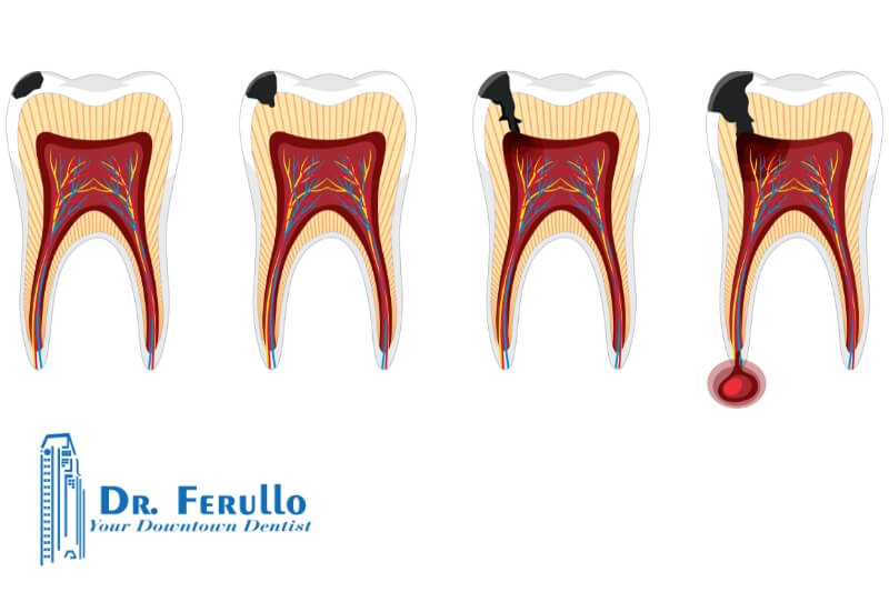 can-tooth-decay-be-reversed