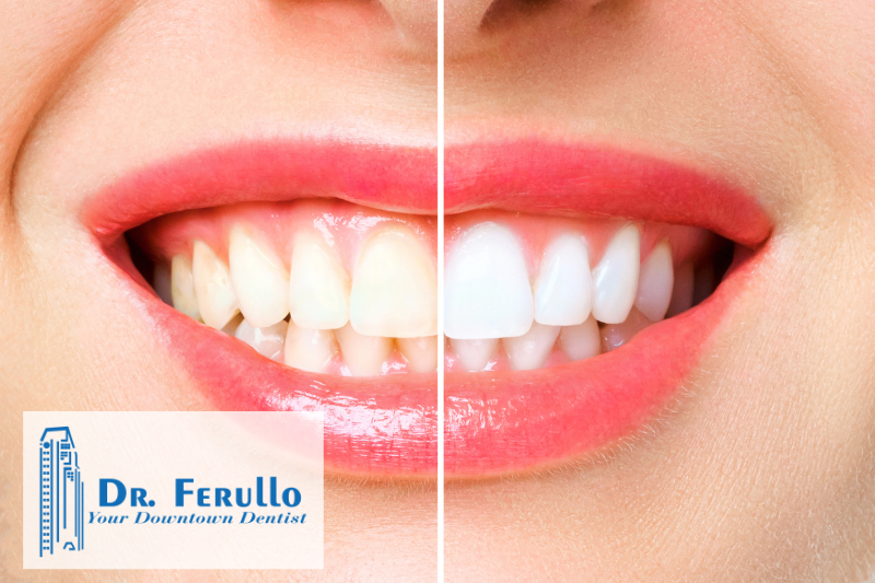 3 facts about teeth whitening you should know